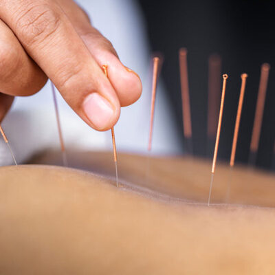 Acupuncture1