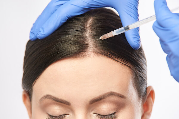 plasma scalp injections