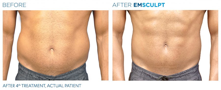 Emsculpt Before And After Man