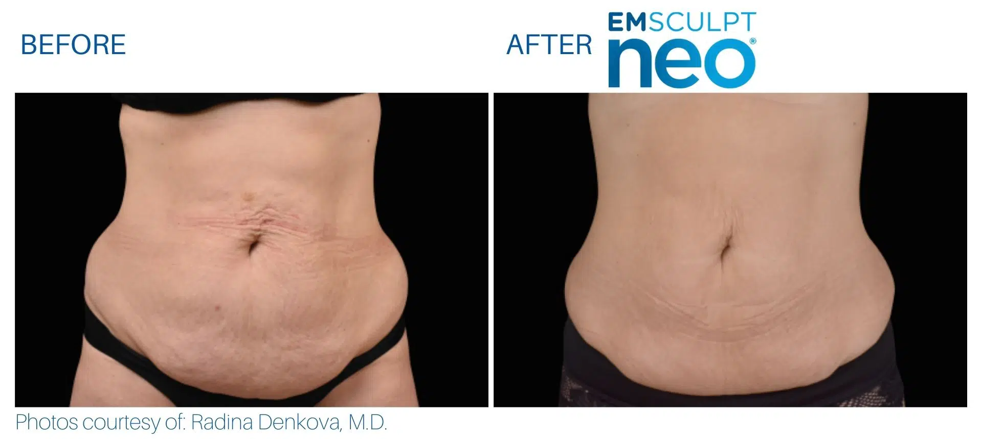 Emsculpt Neo Before And After Pics Juliaedelmanmd 13 Jpg