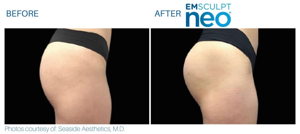 Emsculpt Neo Spa West Westlake Ohio Before And After 1