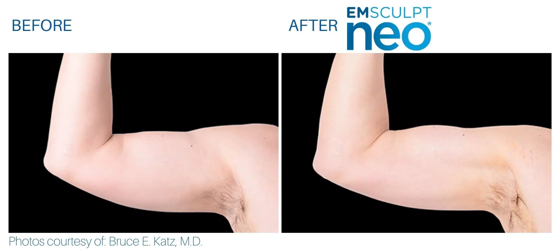 Emsculpt Neo Spa West Westlake Ohio Before And After 3 Jpg