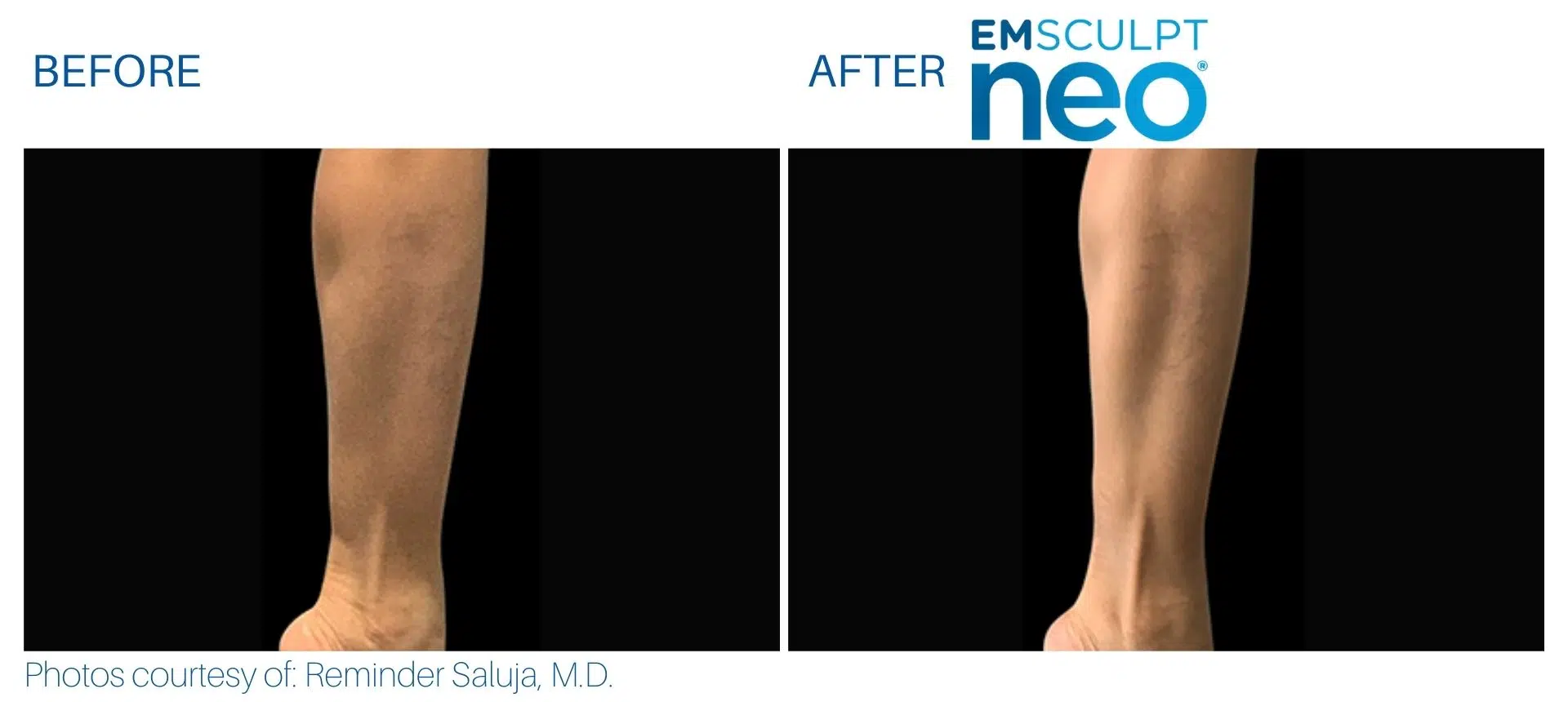 Emsculpt Neo Spa West Westlake Ohio Before And After 4 Jpg